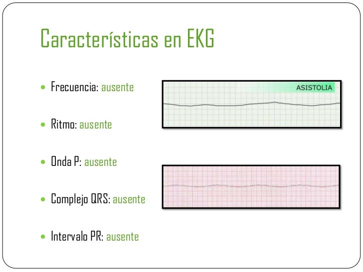 arritmias letales